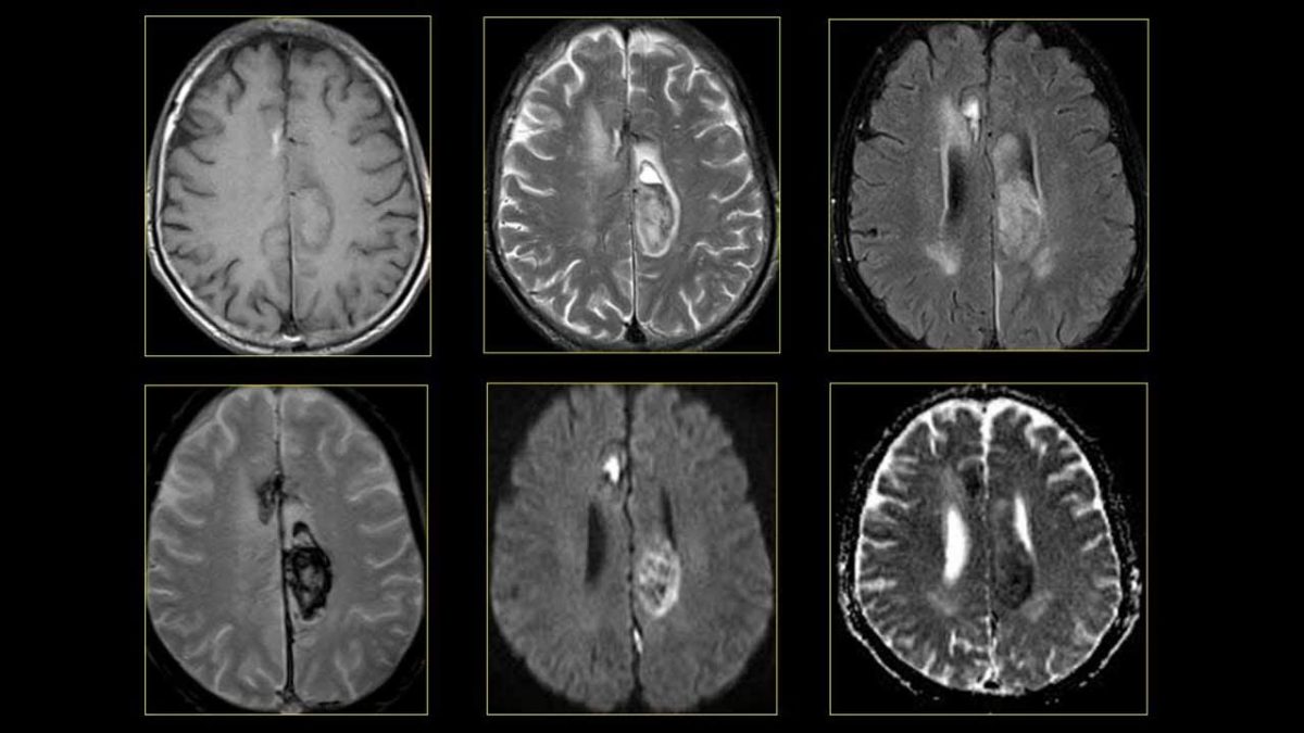 Chụp MRI mạch máu não có tác dụng gì, khi nào cần thiết? | TCI ...