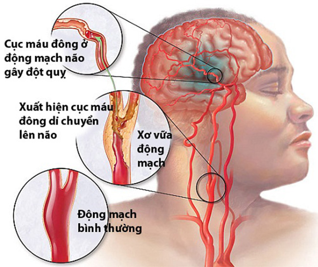 Chụp MRI mạch máu não có tác dụng gì, khi nào cần thiết?