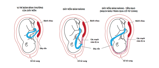 Vị trí Cắm của Dây Rốn Lệch Tâm là gì?