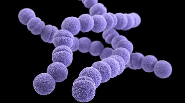 Liên cầu khuẩn nhóm A gây bệnh sốt thấp khớp, viêm nội mạc nhiễm khuẩn là nguyên nhân chủ yếu gây hẹp van 2 lá.