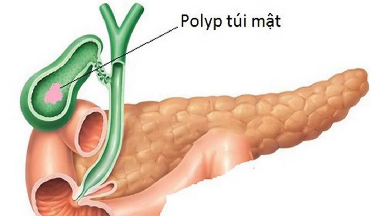 Polyp túi mật 8mm và cách xử lý hiệu quả TCI Hospital