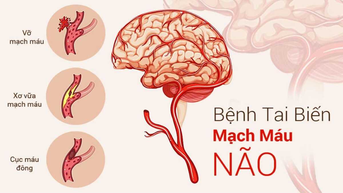 Làm thế nào để nhận biết và phát hiện sớm tai biến méo miệng?
