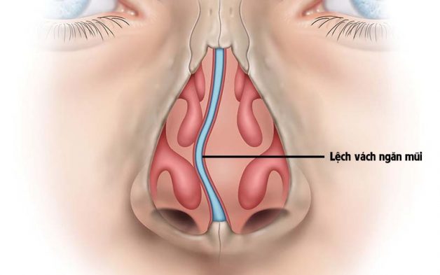 nếu lệch vách ngăn mũi khiến người bệnh khó thở, tắc nghẽn dịch nhầy thì cần điều trị sớm để không tiến triển thành viêm xoang trán