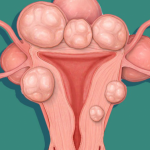 Tổng hợp các phương pháp điều trị u xơ tử cung