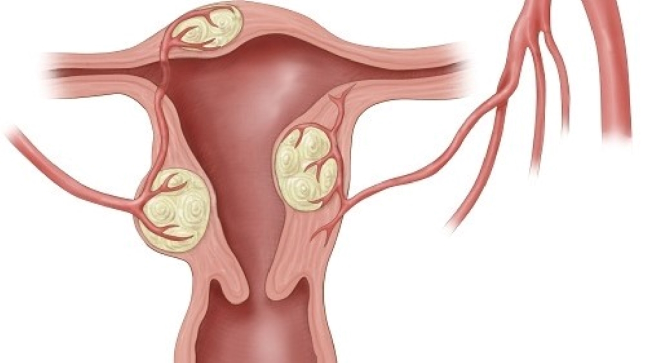 Phẫu thuật bóc u xơ tử cung có nguy hiểm không?
