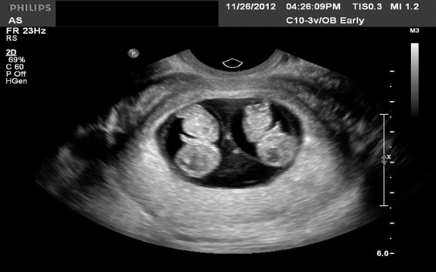 Siêu âm thai 2D là công nghệ hiện đại hỗ trợ chẩn đoán sớm các vấn đề về thai nhi. Hình ảnh chân thực, rõ nét của siêu âm sẽ giúp bố mẹ yên tâm hơn về sự phát triển của con trai hay con gái mình. Hãy xem những hình ảnh đầy cảm xúc này ngay bây giờ!