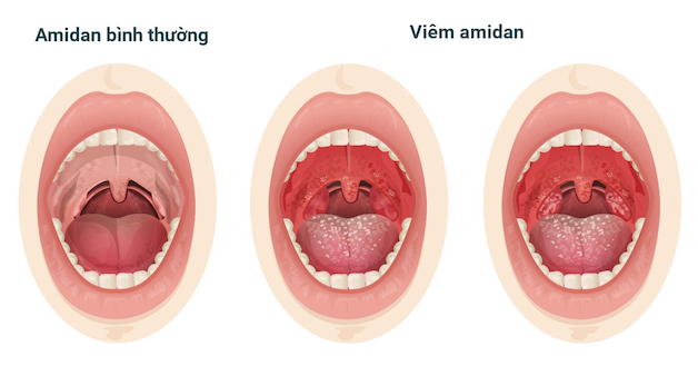 Khi amidan bị nhiễm trùng dai dẳng lâu ngày, tần suất diễn ra liên tục thì được gọi là viêm amidan mãn tính.