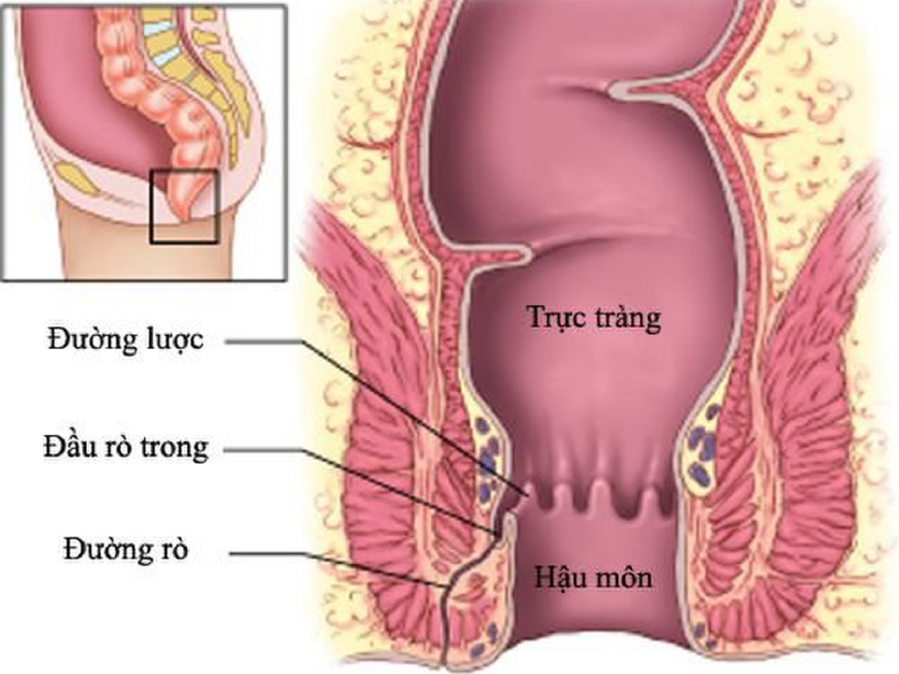 Có thể phòng ngừa và ngăn chặn được rò hậu môn đơn giản không?
