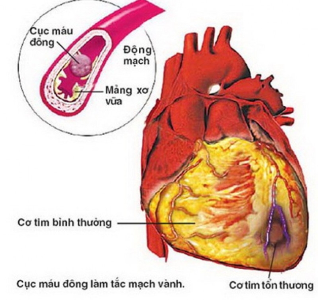 Chụp CT mạch vành – chìa khóa trong điều trị bệnh động mạch vành