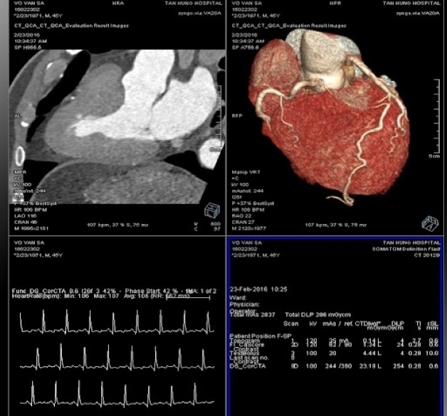 Chụp CT mạch vành – chìa khóa trong điều trị bệnh động mạch vành