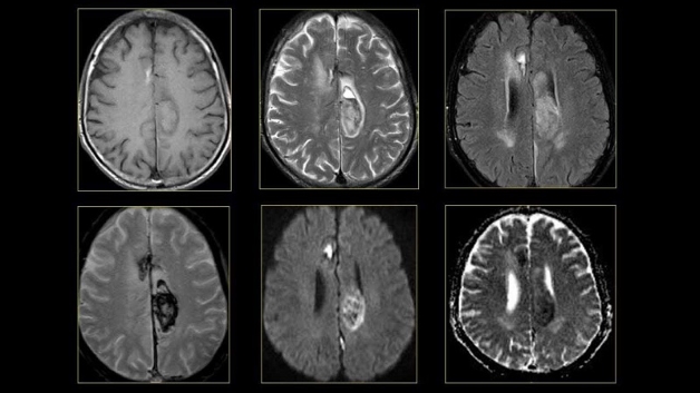 Lợi thế của chụp hình MRI trong chẩn đoán bệnh lý thần kinh, não bộ