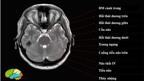 Vai trò của chụp MRI sọ não trong chẩn đoán và điều trị bệnh hệ thần kinh