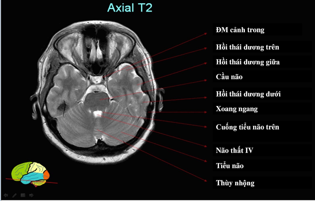 Vai trò của chụp MRI sọ não trong chẩn đoán và điều trị bệnh hệ ...