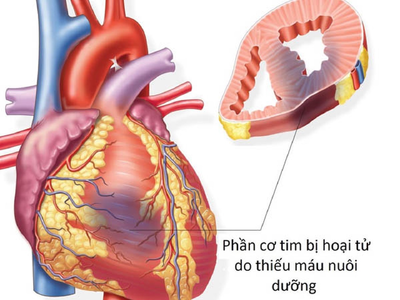 Những dấu hiệu và nguyên nhân nhồi máu cơ tim thành dưới cần được biết