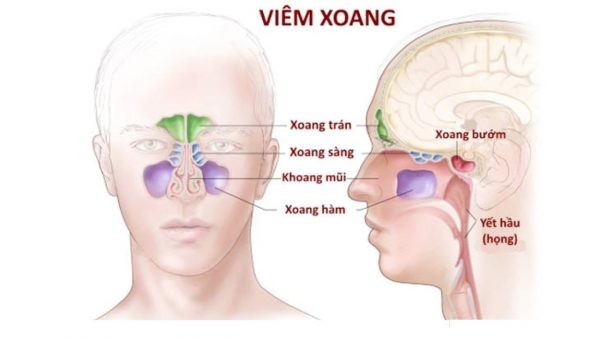 Triệu chứng của viêm xoang sàng sau là gì? Đừng bỏ qua!