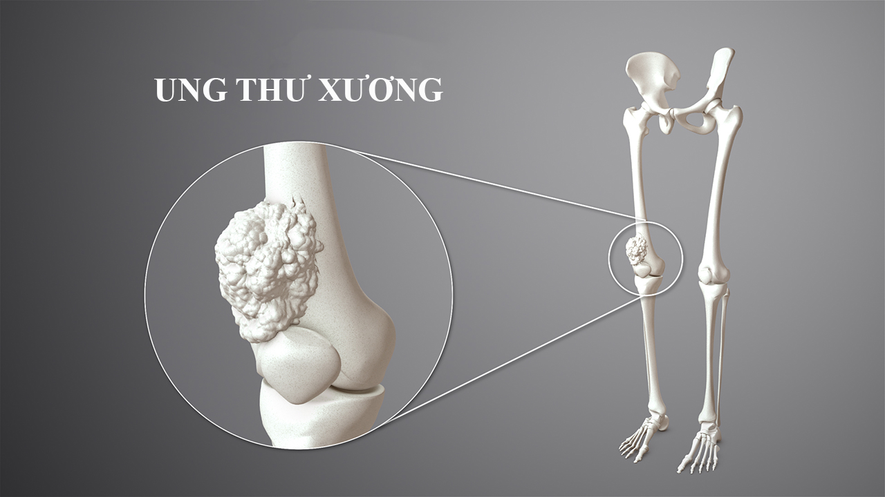 Tìm hiểu ung thư xương chữa được không và phương pháp điều trị