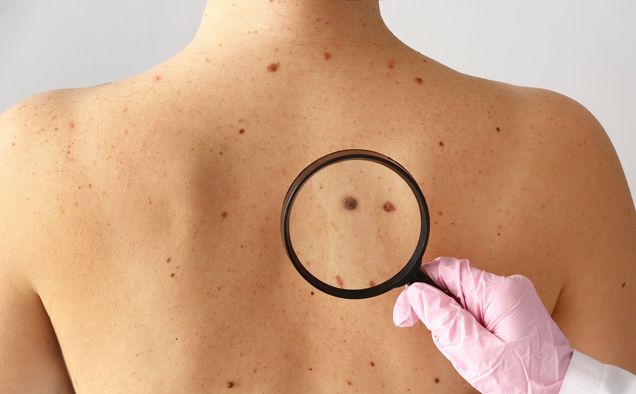 Nhận biết 8 dấu hiệu ung thư da bằng cách nào? | TCI Hospital