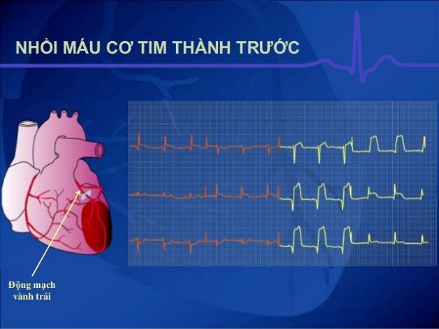 Nhồi máu cơ tim ST chênh lên là gì? 
