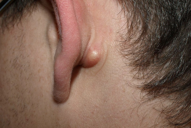 Hình ảnh người bệnh bị nổi cục ở tai