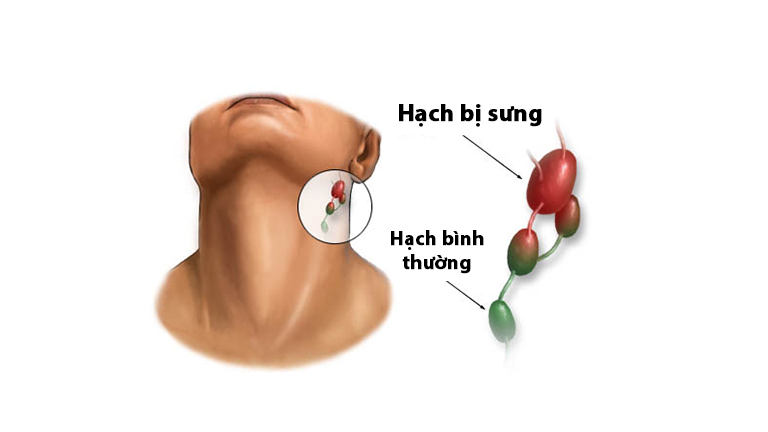 Minh họa hạch bạch huyết tai bình thường và bị sưng