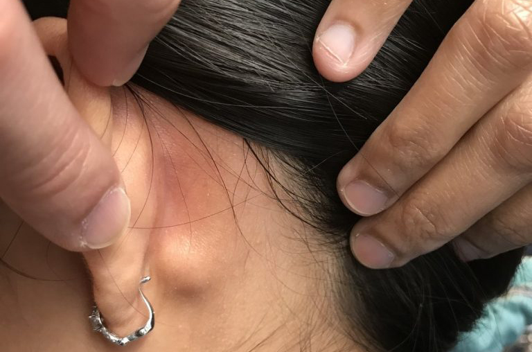 Nổi hạch sau tai là một hiện tượng không hiếm gặp do nhiều nguyên nhân khác nhau gây nên