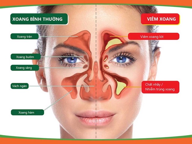 Xoang là hệ thống gồm các hốc rỗng, nằm sâu trong các hốc xương ở quanh vùng sọ mặt.