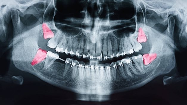 Nhổ răng khôn khi nào lành? Cần lưu ý gì sau khi nhổ răng khôn?