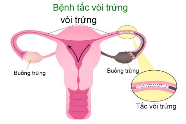 Tắc vòi trứng là bệnh gì?