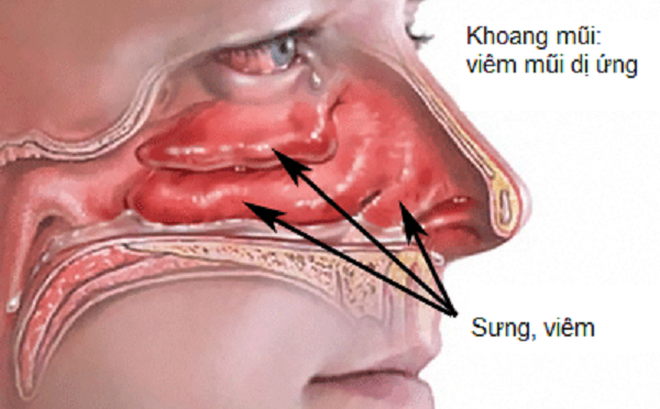 Hình ảnh minh họa xoang mũi khi viêm mũi dị ứng