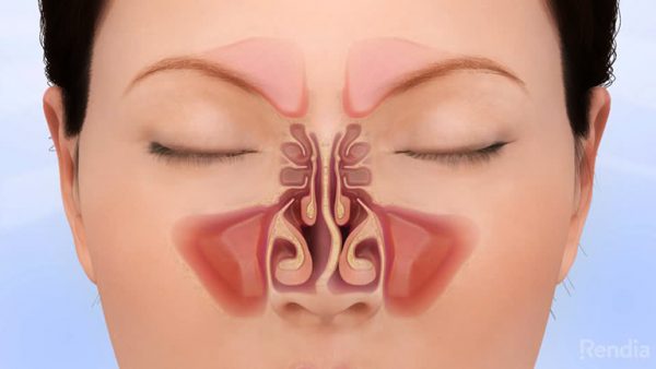 Sự bất thường trong cấu trúc mũi làm gia tăng sự nhạy cảm của niêm mạc mũi, làm phát sinh viêm mũi dị ứng