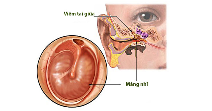 Vị trí tai giữa và mô phỏng tình trạng viêm tai giữa