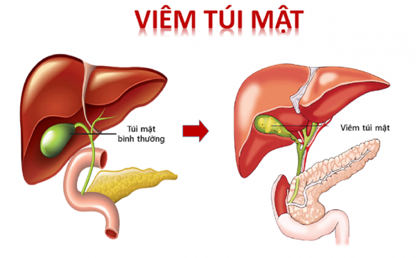 Viêm túi mật cấp tính là gì?