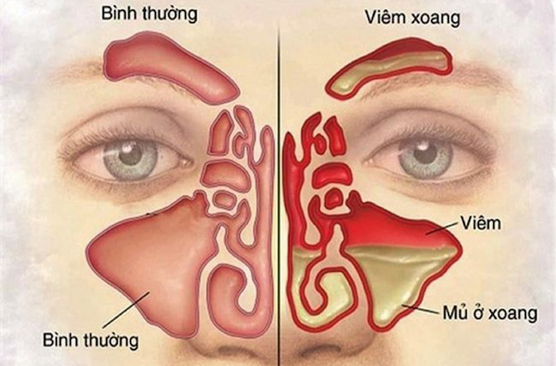 Viêm xoang mạn tính là hiện tượng các mô xoang trong mũi vị viêm gây ra tình trạng sưng phù kéo dài đến hơn 12 tuần.