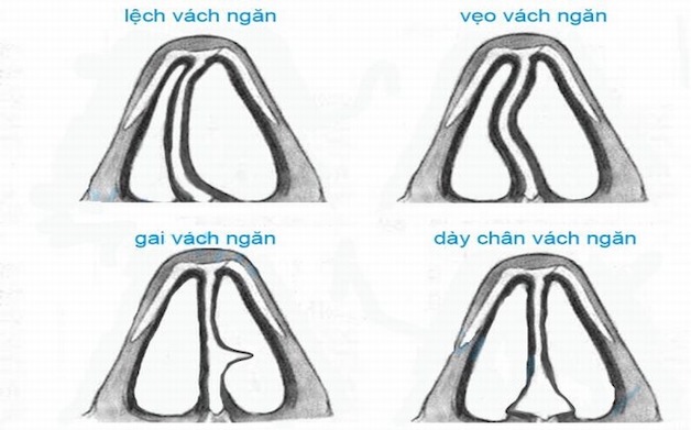 Những người có cấu trúc vách ngăn mũi bất thường (lệch, vẹo, có gờ...) hoặc hốc xoang nhỏ, hẹp, có polyp... thường có nguy cơ mắc bệnh cao hơn.