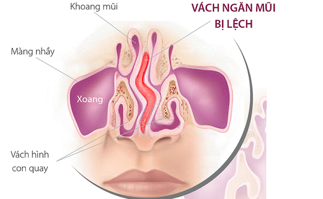 Vách ngăn mũi có gờ hoặc bị lệch vẹo là một trong những nguyên nhân gây viêm hốc xoang trán.