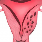 Siêu âm lạc nội mạc tử cung có thấy rõ tình trạng bệnh không?