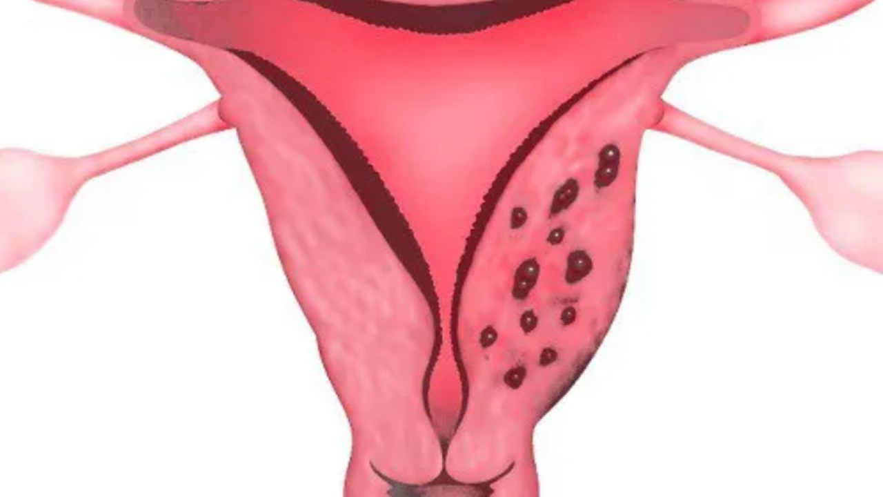 What are the symptoms and diagnosis of lạc nội mạc tử cung on ultrasound?