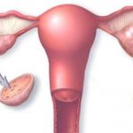 Vòi trứng thông hạn chế và khả năng mang thai của phụ nữ