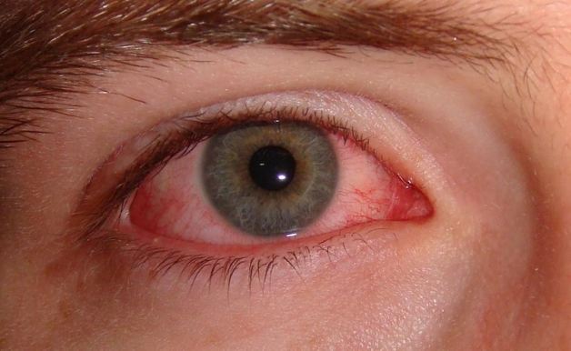 Mắt hột là một dạng bệnh lý do vi khuẩn Chlamydia Trachomatis gây ra, có khả năng phát triển thành mãn tính nếu như không được điều trị và rất dễ lây lan thành dịch