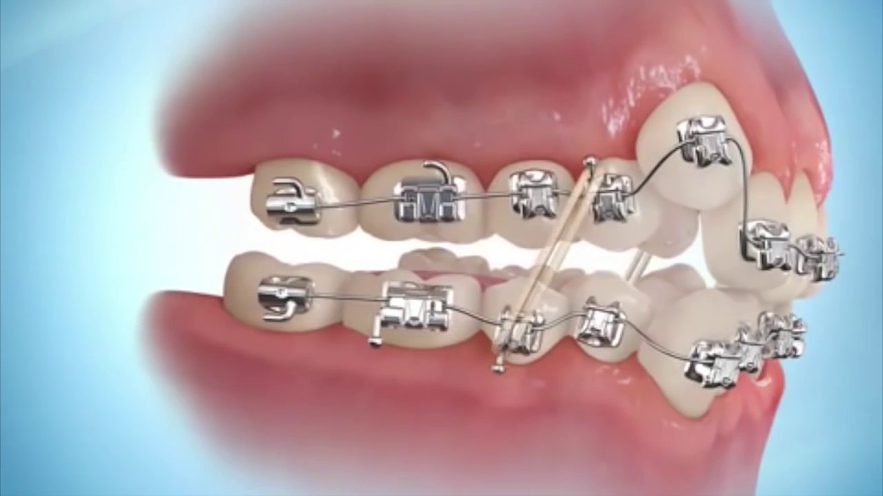 Tham khảo về quy trình niềng răng mắc cài kim loại và ưu điểm của nó