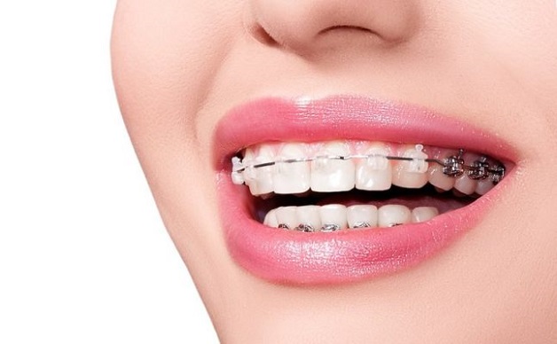 Niềng răng là phương pháp sử dụng khí cụ chuyên dụng để giúp răng có thể di chuyển về đúng vị trí mong muốn trên cung hàm.