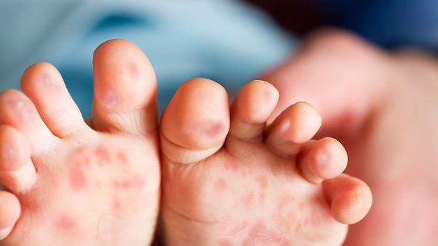 Trẻ nhỏ khi bị bệnh tay chân miệng cấp độ 1 sẽ có biểu hiện mệt mỏi, sốt cao từ 38 đến 39 độ C. Sau đó, cơ thể của trẻ sẽ xuất hiện các bọng nước trên da, đặc biệt là ở khu vực miệng, mông, tay, chân.