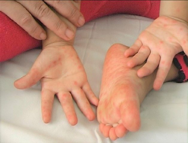 Chân tay miệng là căn bệnh thường gặp ở trẻ em