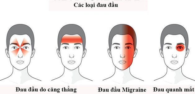 đau nửa đầu nguyên nhân mạch máu não - Migraine