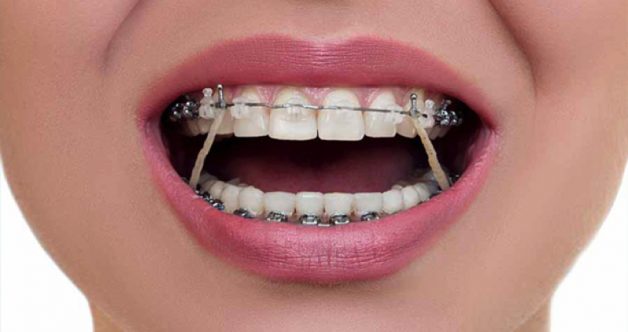 So với các phương pháp khác, niềng răng mất một thời gian khá lâu để điều chỉnh răng (18 - 24 tháng), tuy nhiên lại mang đến hiệu quả cao và có tác dụng lâu dài.