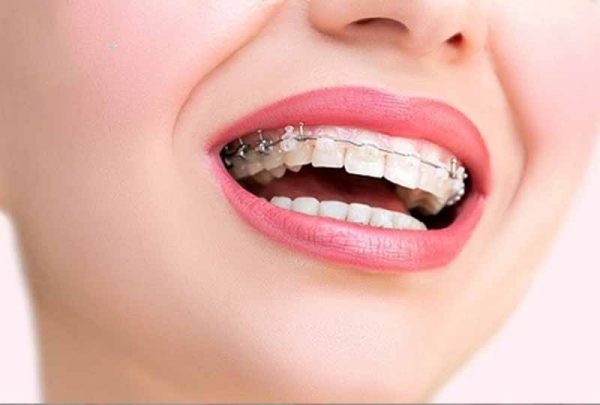 Vấn đề niềng răng 1 hàm có được không còn phải phụ thuộc rất nhiều vào tình trạng răng miệng