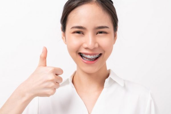 Niềng răng 1 hàm chủ yếu được áp dụng cho những trường hợp sai lệch nhẹ, ví dụ hô nhẹ, móm nhe, hoặc mức độ lệch lạc của răng không đáng kể
