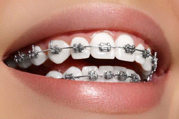 Niềng răng là phương pháp sử dụng các khí cụ nha khoa nhằm cải thiện các sai lệch ở răng