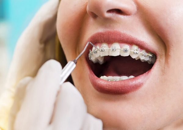 Với thắc mắc niềng răng có ảnh hưởng gì không, bạn nên chú ý đến hiện tượng tiêu chân răng bởi đây là hiện tượng có thể gặp phải trong quá trình chỉnh nha