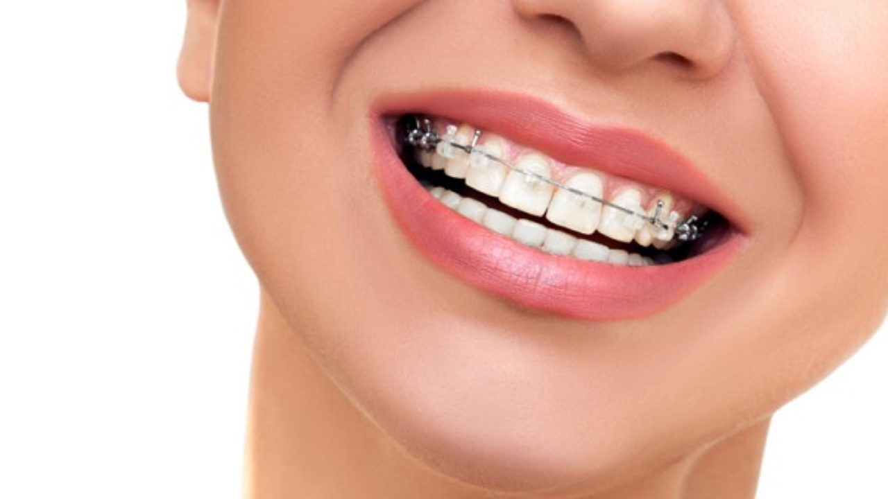 Phản ứng dị ứng có thể xảy ra sau khi niềng răng?
